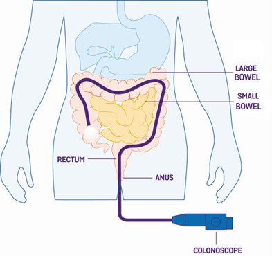 Diagram of the torso showing the colonoscope travelling through the rectum into the bowel