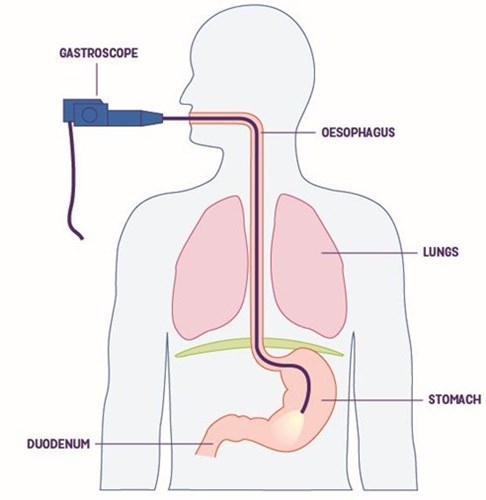 Diagram of the human body showing the gastroscope going down the oesophagus and into the stomach