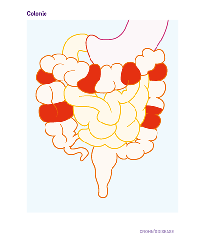 Diagram of the gut showing where colonic Crohn's occurs. The highlighted area is throughout the large bowel.