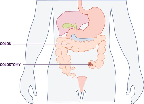 colostomy graphic