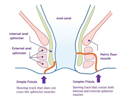 graphic of fistulas simple and complex