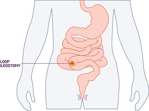 loop stoma graphic