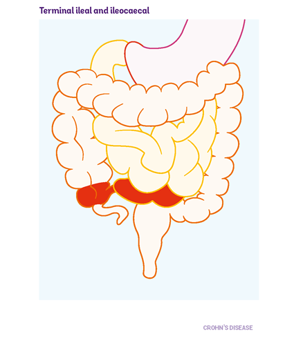 Diagram of the gut showing where terminal ileal and ileocaecal occurs. The highlighted area is the last part of the small bowel.