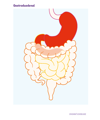Diagram of the gut showing where gastroduodenal Crohn's occurs. The highlighted area is the upper part of the gut- the oesophagus (throat), stomach and the first part of the small bowel (called the duodenum),