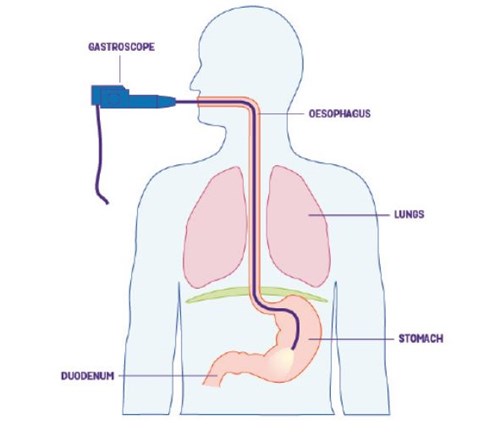 gastroscopy graphic