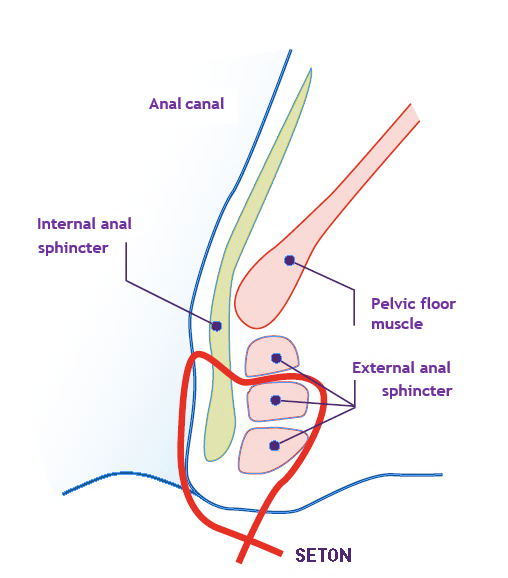perianal fistula crohns
